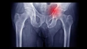 Acetabular Fracture Diagnosis Chillicothe, OH