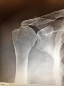 Rotator Cuff Tear Arthropathy X-Ray