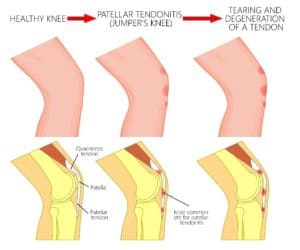 Patella (Kneecap) Tendonitis Infographic Chillicothe, OH