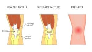 Kneecap Fracture Treatment Chillicothe, OH