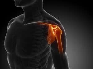 Shoulder X-Ray Illustration for Shoulder Replacement Patients Grove City, OH