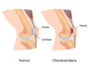 Chondromalacia Patella Treatment for Columbus & Grove City, OH patients