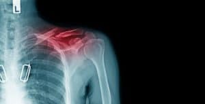 Clavicle Fracture Treatment Chillicothe, OH