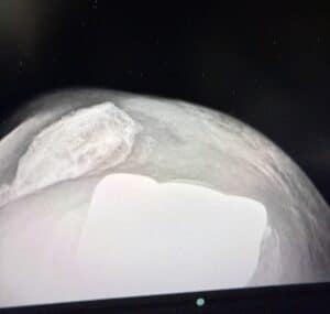 Patient Testimonial: Finding Strength, Confidence, and Relief with Dr. Brian Cohen