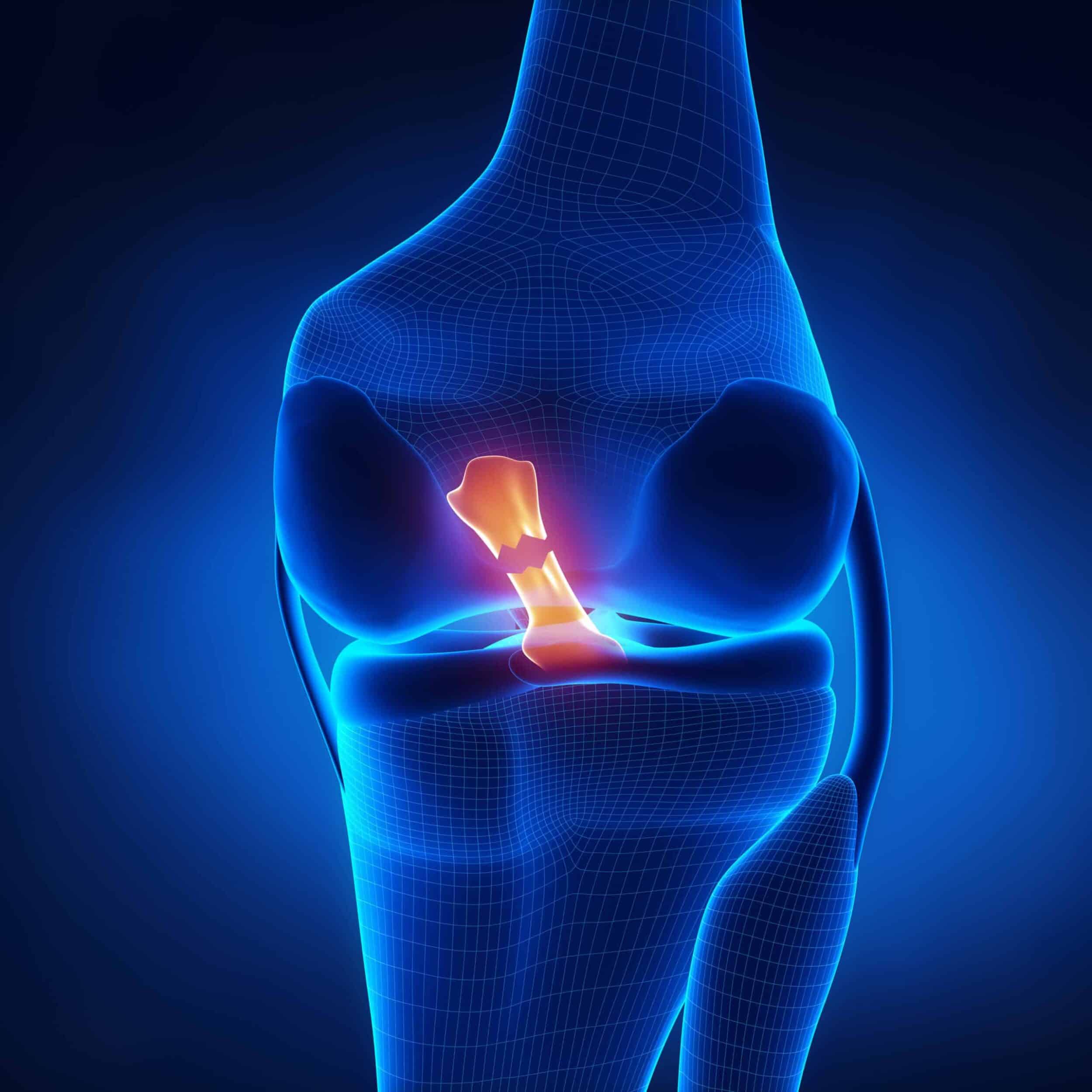Illustration of the anterior cruciate ligament (ACL) in the knee.