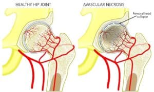 Avascular Necrosis (AVN) Infographic Chillicothe, OH