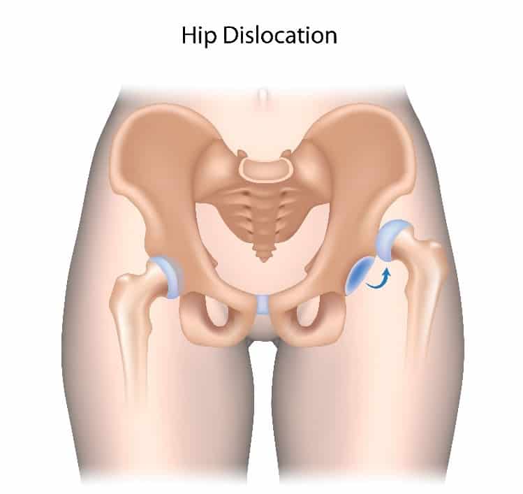 Dislocated Hip Treatment Chillicothe, OH