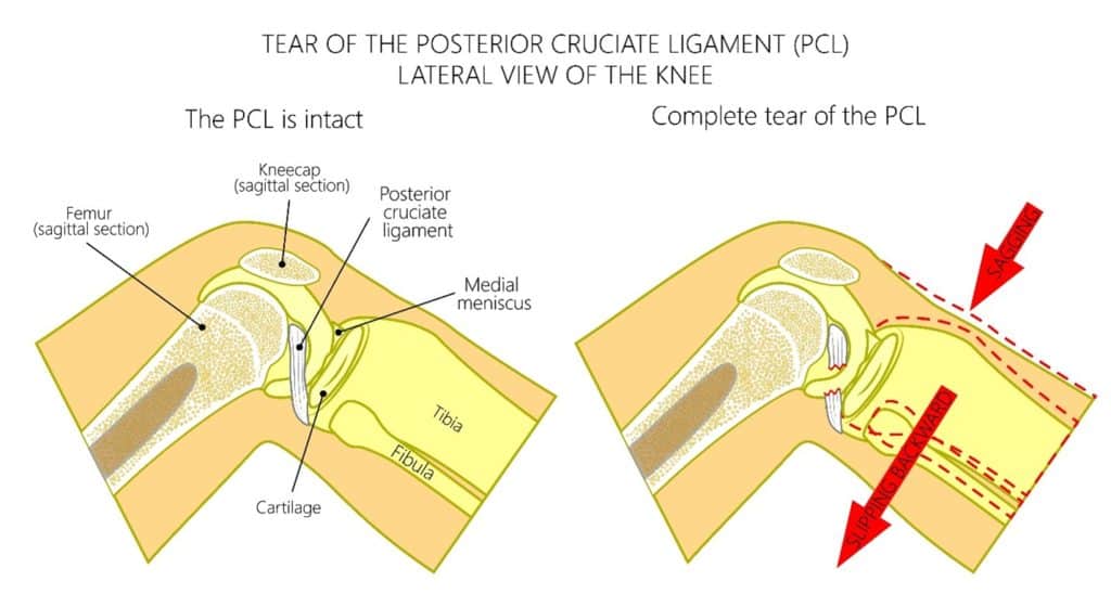 Comparing a healthy knee with a knee with a torn PCL