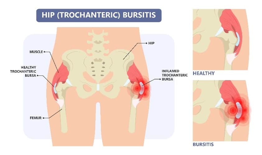 Hip Bursitis Infographic Chillicothe, OH
