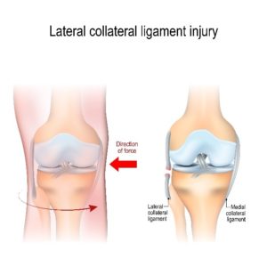 Collateral Ligament (MCL/ LCL) Injury Infographic
