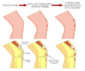 Patella (Kneecap) Tendonitis Infographic Chillicothe, OH