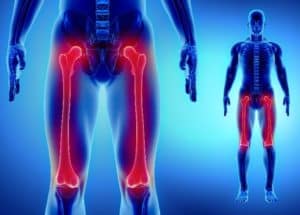 Distal Femur Fracture Treatment for Columbus & Grove City, OH patients
