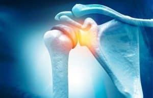 Rotator Cuff Injury Treatment Chillicothe, OH