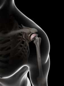 Shoulder Illustration after Total Shoulder Replacement