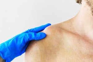 Clavicle Fracture Treatment Chillicothe, OH