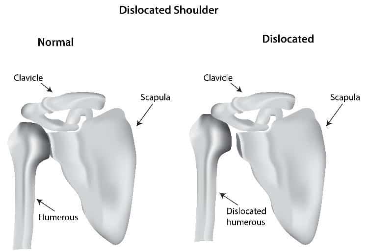 Dislocated Shoulder Treatment Chillicothe, OH