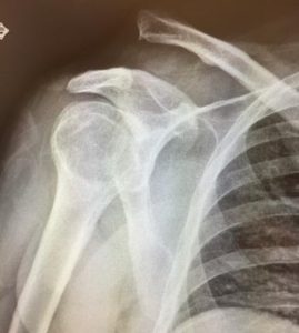 AC Joint Separation X-Ray Chillicothe, OH
