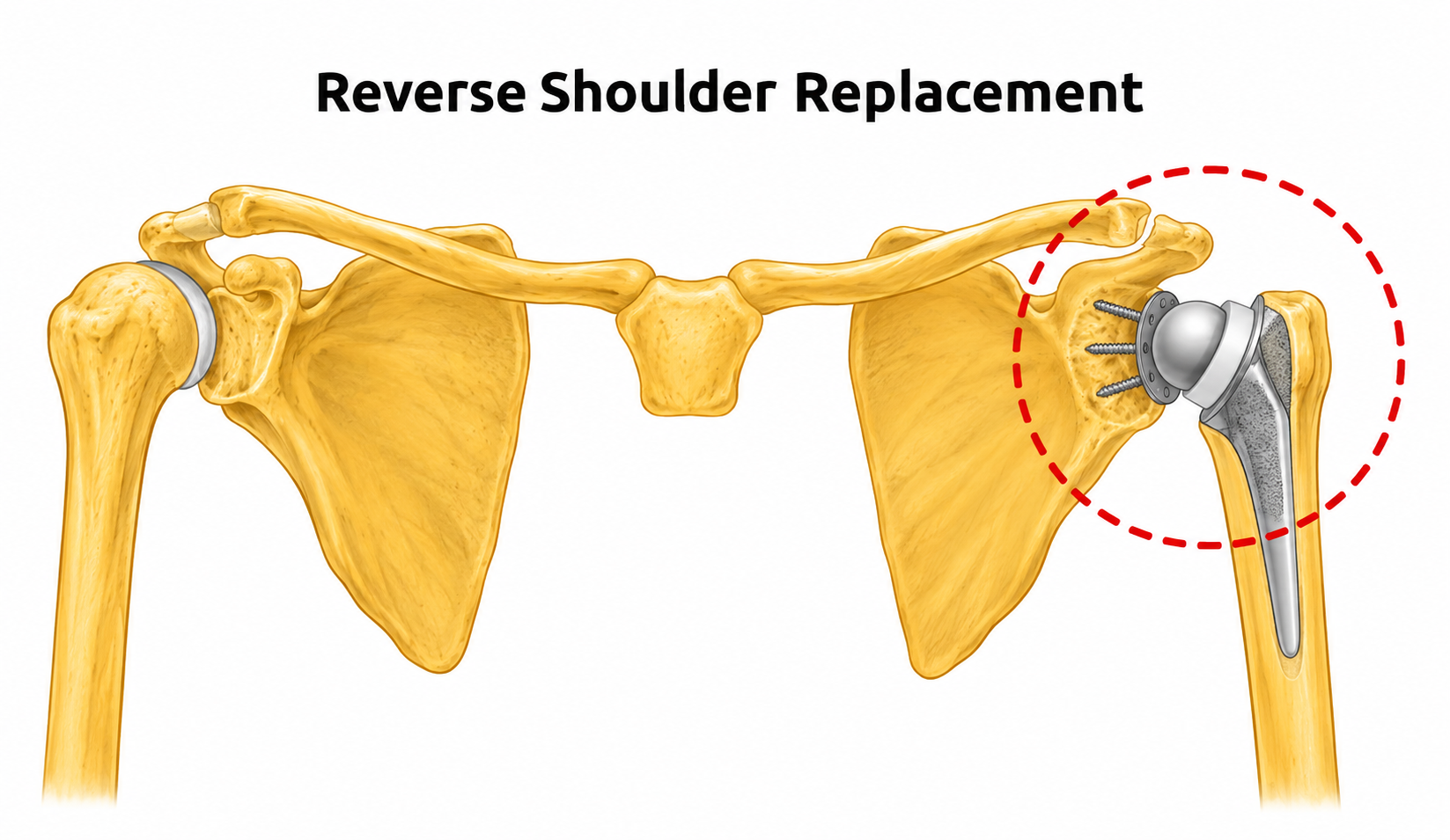 Reverse Shoulder Replacement