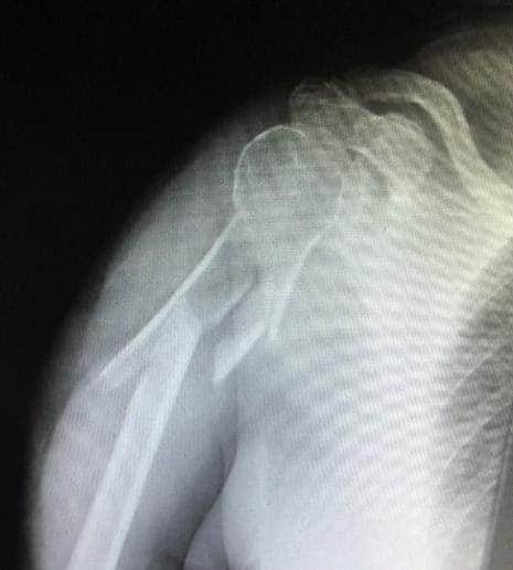 Shoulder Fracture X-Ray Chillicothe, OH