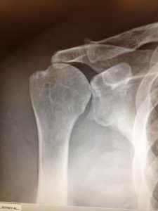 Rotator Cuff Tear Arthropathy X-Ray