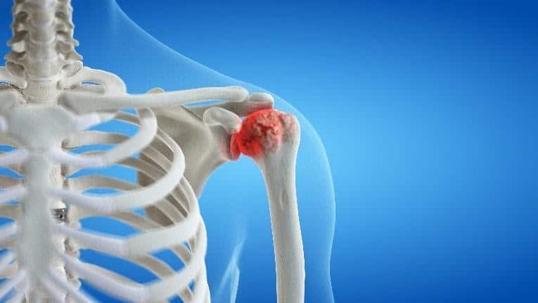Shoulder Arthritis Treatment Chillicothe, OH