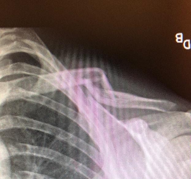Clavicle Fracture X-Ray Chillicothe, OH